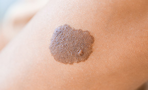 Melanoma Treatment NYC
